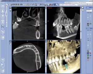 Röntgenbilder von Zahnimplantaten im Kiefer