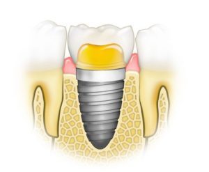 Modell eines Zahnimplantats im Kiefer