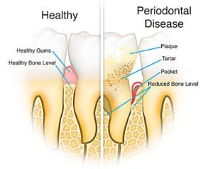 Vergleich: gesundes Zahnfleisch und erkranktes Zahnfleisch