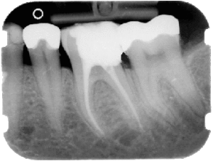 Bild eines wurzelbehandelten Zahns